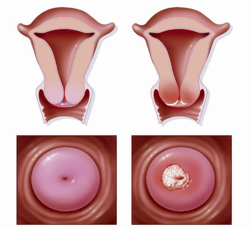 宫颈癌"潜伏期",子宫发出7个"信号"当心宫颈癌