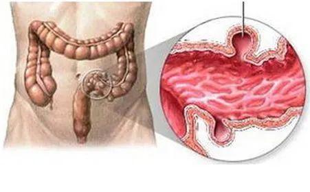 肠炎有什么症状的表现