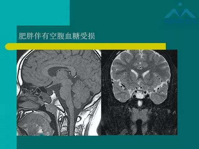 儿童rathke裂囊肿的影像与临床
