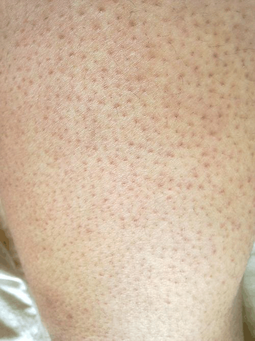 有好多mm被鸡皮肤所困扰,鸡皮肤即毛囊角化症,是在胳膊上,腿上那些一