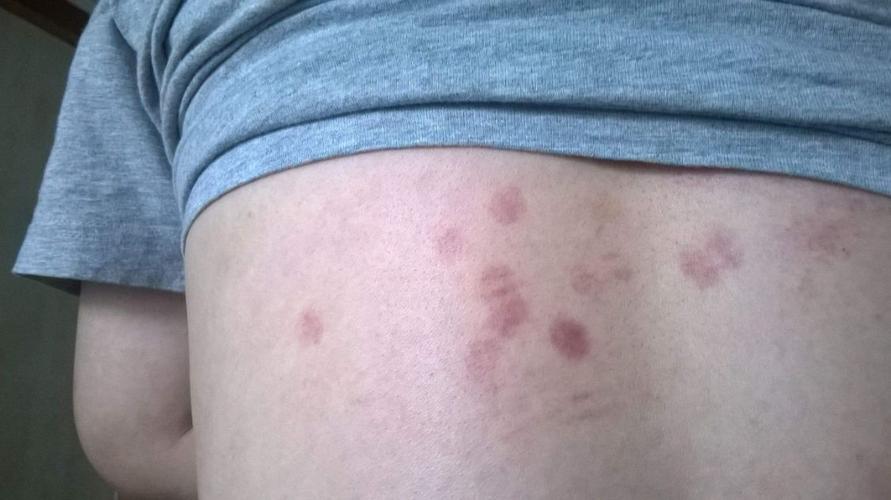 癌细胞,皮肤,黑棘皮症,癌症,红斑,细胞,肿瘤,皮肤瘙痒