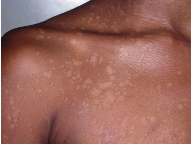 身上突然白了一块会不会是别慌教你几招轻松辨别白斑