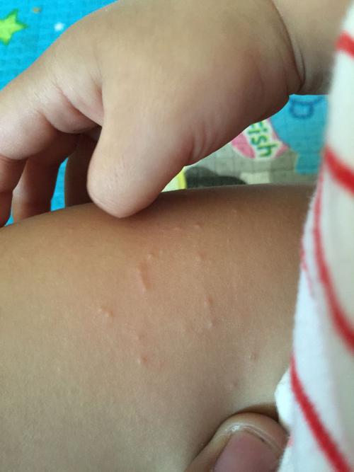 小孩子腿上长了疙瘩,这是什么?