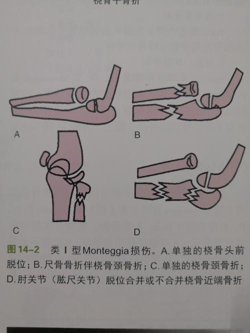 一例复杂性类孟氏骨折闭合复位弹性髓内钉内固定病例分享