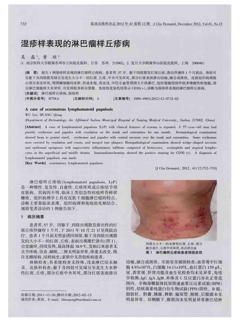 期刊湿疹样表现的淋巴瘤样丘疹病被引量:2    报告1例湿疹样表现的