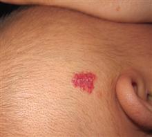 婴儿血管瘤严重吗 安徽血管瘤医院