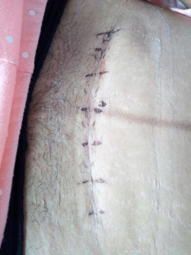 二次刨妇产刀口