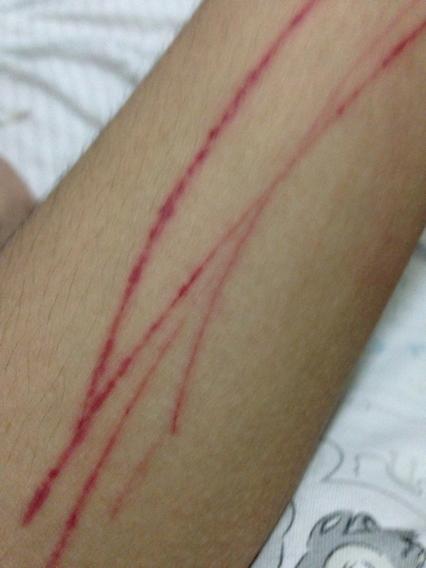 手划伤了怎么快速好呢?