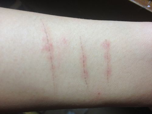 我的胳膊被消毒液泡过的刀片划伤了,贴了两天的邦迪后