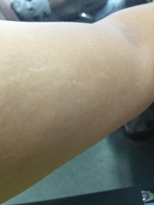 这是肥胖纹吗?隐隐感觉是一条一条的 脸上