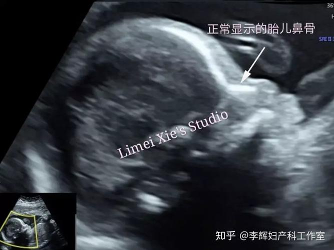 胎儿鼻骨缺失和或发育不良的医生专业指导