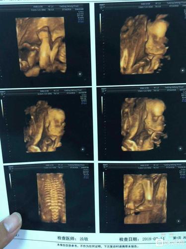 24周四维已通过,猜猜是男孩还是女孩