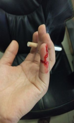 不小心割破了手指,看着鲜血滴答滴答的感觉有些晕,心跳加速,额头冒发