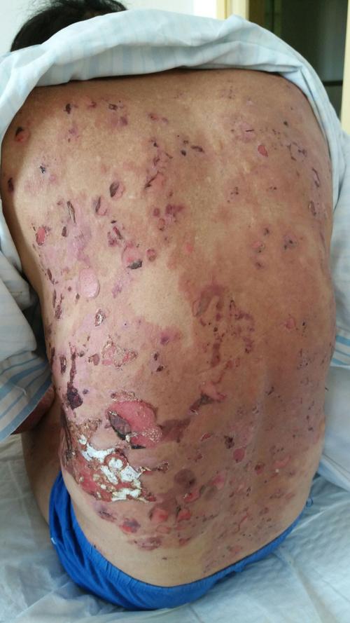 大疱性类天疱疮