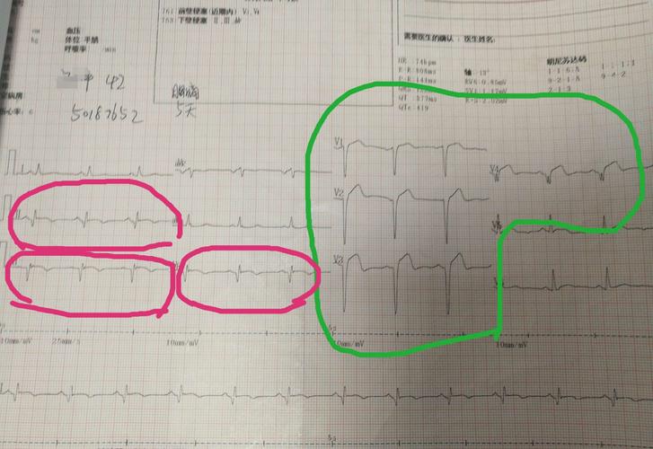 心电图提示陈旧下壁心肌梗死(红圈),前壁新发心梗(绿圈)