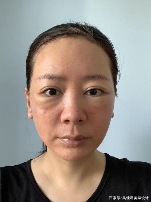 术前术后对比,面部皱纹少了,脸变短了也变瘦了,皮肤也变好了,整个