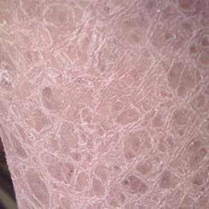 鱼鳞病都有哪些常见的症状?_邯郸燕赵中医皮肤病医院