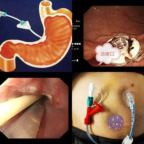 哈医大四院消化内科内镜微创胃造瘘技术(peg)解决肠内营养问题