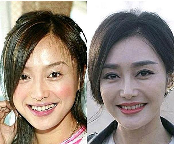 但你知道吗,早期秦岚并没有那么美,五官也没有那么精致,脸还甚至有些