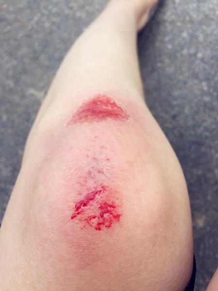 赶快回到车里,先用碘伏消毒,再用创可贴包扎伤口.