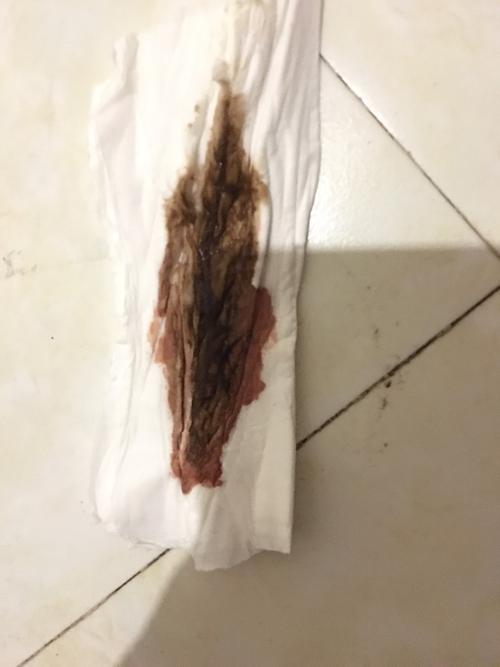 褐色分泌物带图 这个不是血 是不是很严重