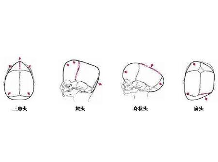 狭颅症宝宝的表现