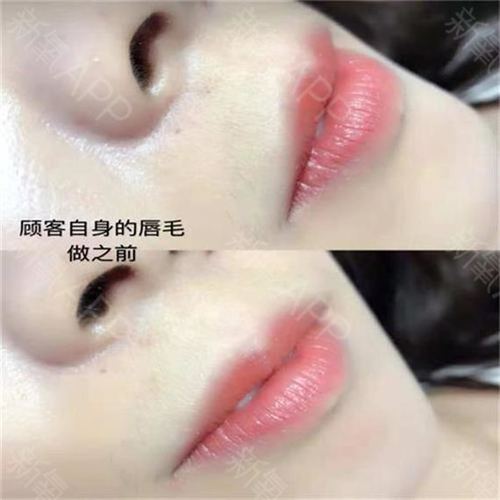 新氧- 氧气xupml | 激光脱毛 | 术后当自强 | 武汉同城 | 脱唇毛