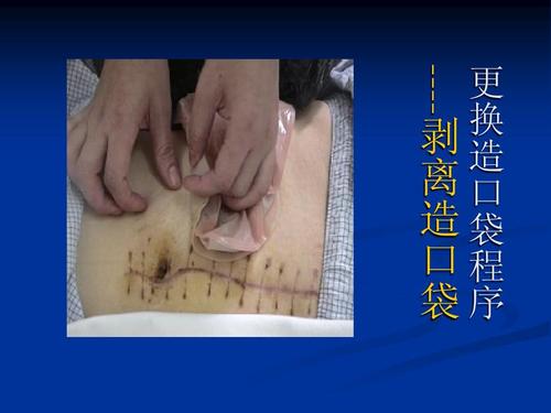 肠造口术后护理ppt
