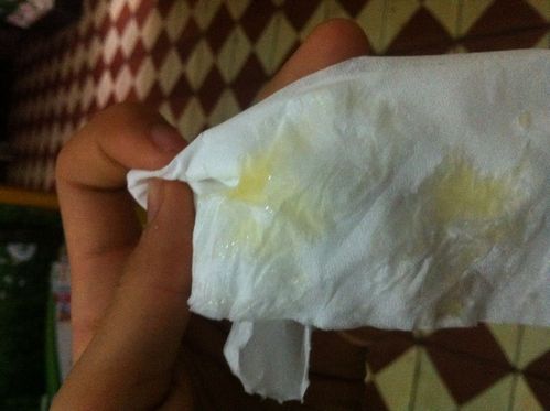 我的精液是黄的,上图,帮忙看看正常吗?15岁