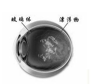 飞蚊症要如何治疗才可以治好呢