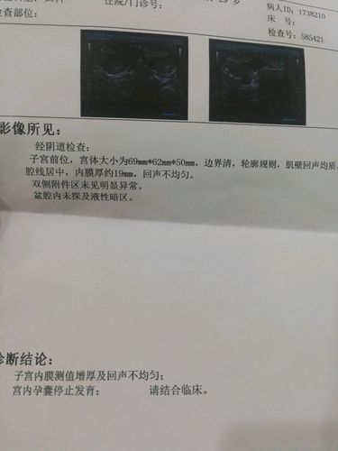 2019年4.月14号胎停育