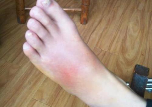 退休中医:痛风早期4个症状,别再忽视!