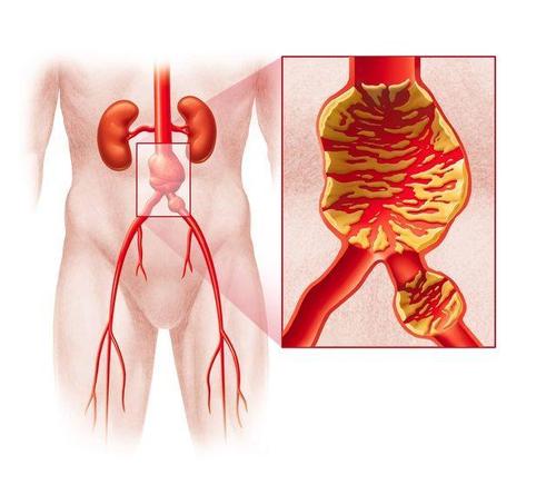 腹主动脉瘤