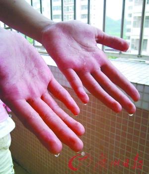 女孩双手爱"哭泣" 13年来不敢主动和人握手