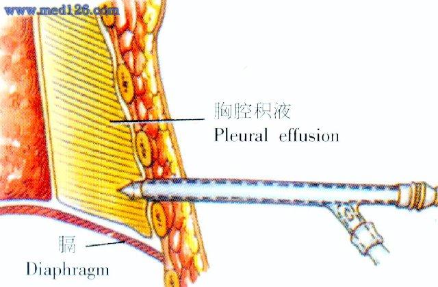 胸膜腔闭式引流术肋间径路