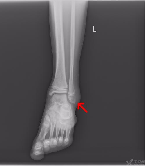 39-外踝骨折 m11y外伤后左外踝肿痛,活动受限1小时余