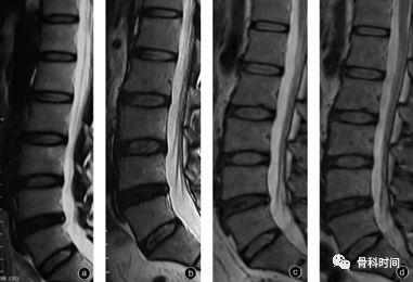 椎间盘高信号区都代表纤维环撕裂吗?