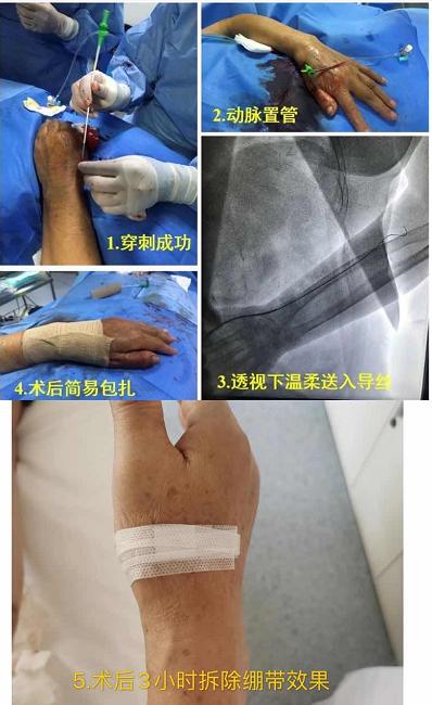 在常规桡动脉穿刺置管成功后却无法顺利送入造影导管,后经造影证实