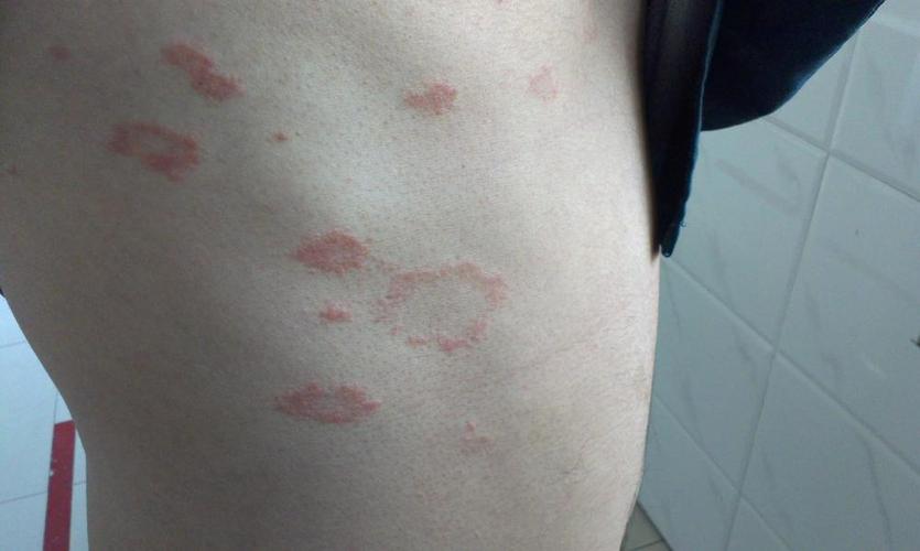 红斑狼疮可累及全身,若是身体出现这5种症状,及时就医