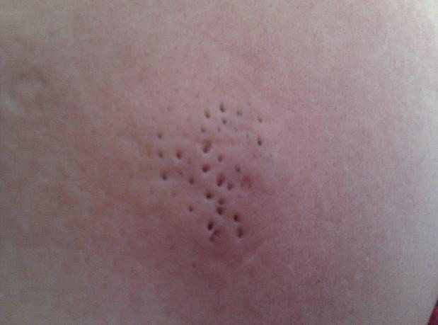 背部长痘搓澡搓出大量泥垢,原来是螨虫排泄物,排螨3方法搞定!