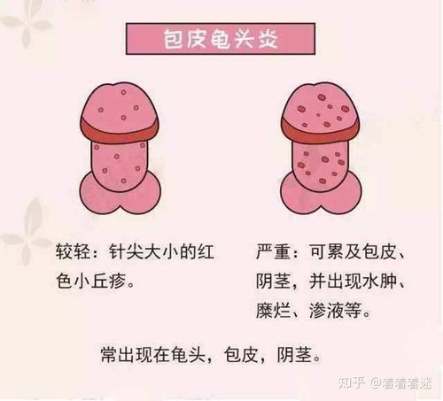 男科医生李墨农普及:你知道龟头炎的症状以及危害吗?