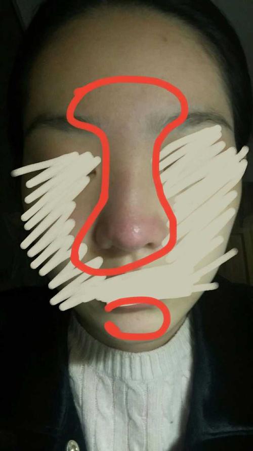 (红鼻子 )