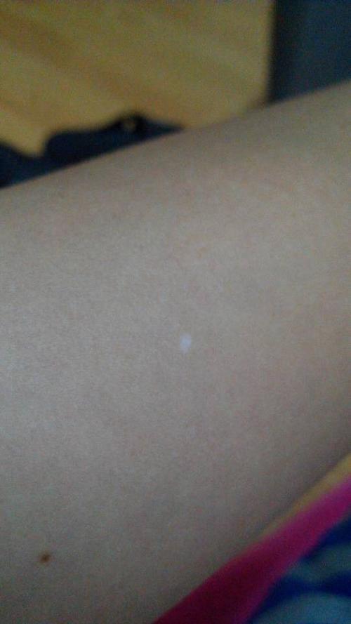 问:左手臂,右大腿,左右1腿都有1个白斑,是什么病?