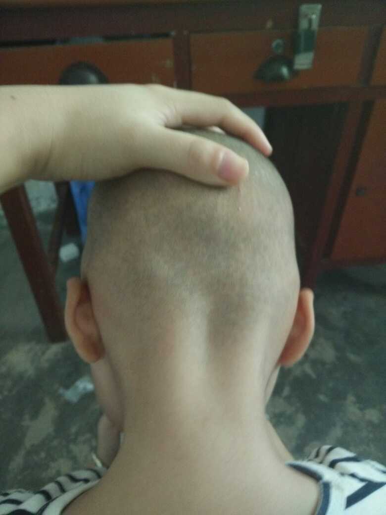 宝宝后脑勺有个很明显的包块可以移动,有没有宝妈知道是怎么回事啊?