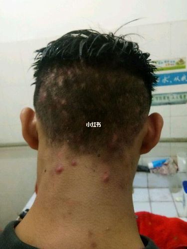 毛囊炎终于没有啦! 后脑勺上面长了好多红红的小疹子