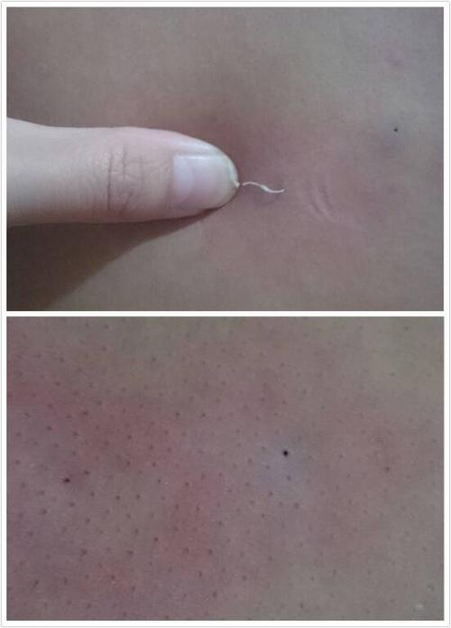 后背长出来的一种奇怪东西,好几年了,不定期的挤一下会挤出很多橡皮泥