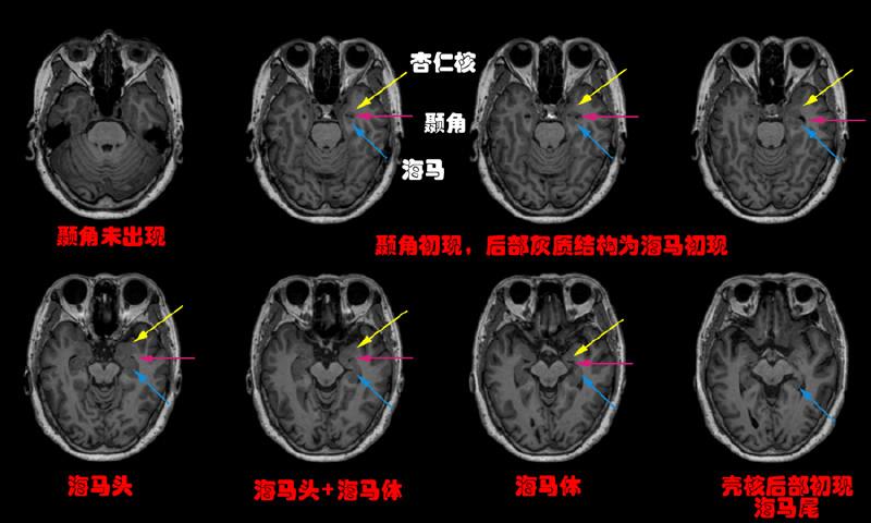 黄色箭头示杏仁核,粉红色示颞角,蓝色箭头示海马.