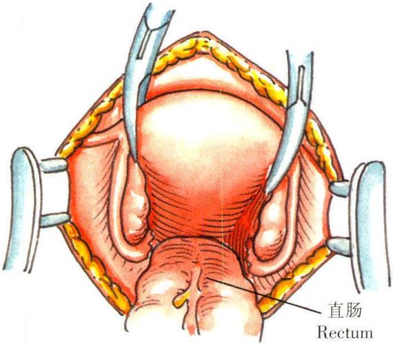筋膜外扩大全子宫切除术
