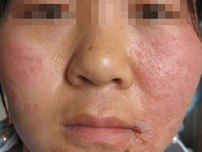 冬季皮肤干燥脱皮