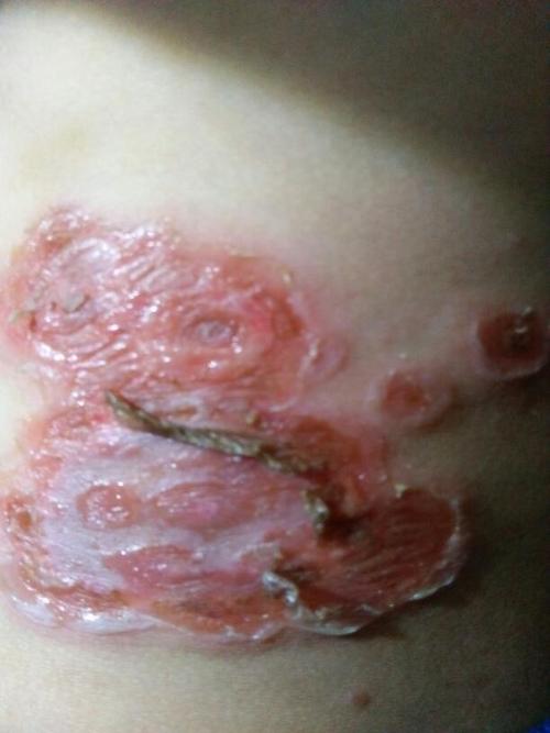 请问我弟弟生什么了?怎么皮肤溃烂了?